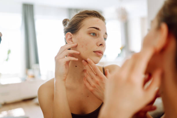 How to Deal with Acne: Best Practices and Products