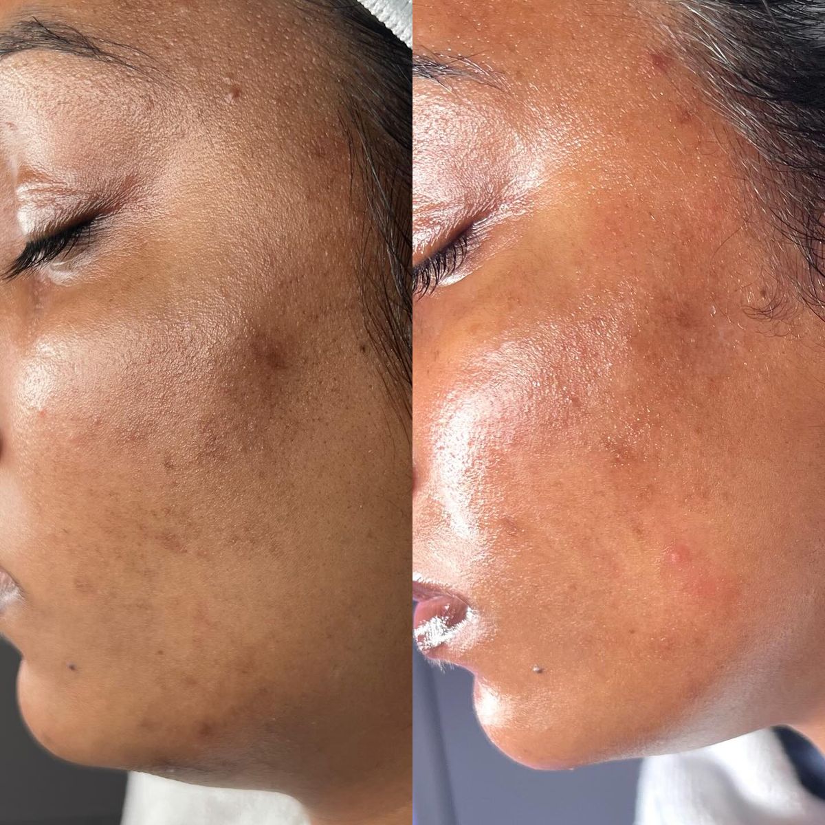 Pigmentation Removal: Understanding Causes and Effective Treatment Options