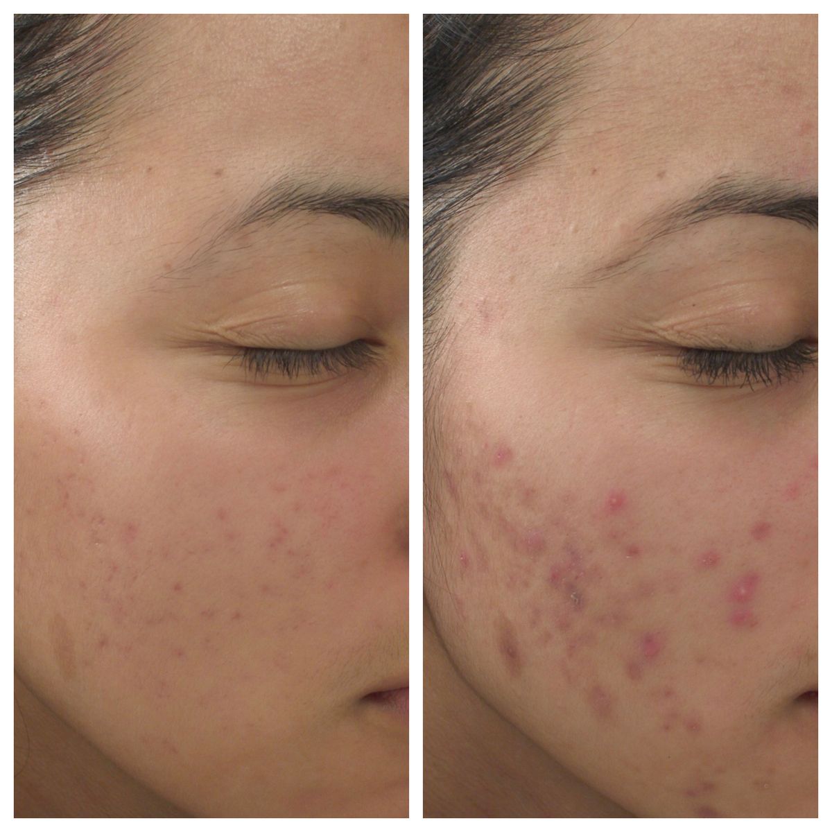 Understanding Pigmentation Removal and Treatments